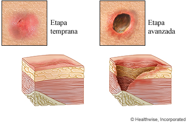 Lesiones por presión en etapa temprana y etapa avanzada