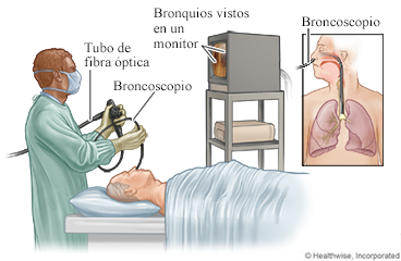 Tubo con una cámara que se introduce en la tráquea para observar los bronquios en un monitor