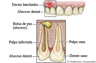 Diente sano y diente con un absceso