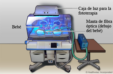 Bebé recibiendo fototerapia para la ictericia