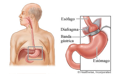 Esófago y estómago, con detalle del esófago, el diafragma, la banda gástrica y el estómago