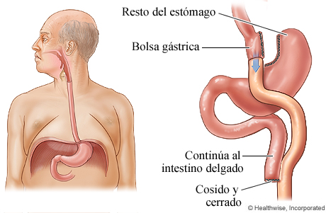 Cirugía de derivación gástrica para la obesidad