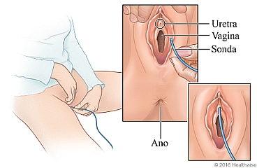 Mujer introduciéndose la sonda, con detalle de la uretra, la vagina y la colocación de la sonda.