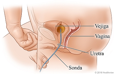 Vista lateral de la anatomía femenina, donde se muestra la colocación de la sonda.