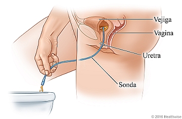 Vista lateral de la anatomía femenina, donde se muestra el drenaje de la vejiga con una sonda.