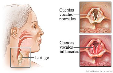 Ubicación de la laringe en el cuello, con detalle de las cuerdas vocales normales y una inflamación de las cuerdas vocales