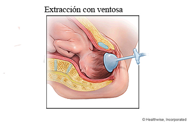 Extracción con ventosa