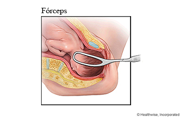 Parto asistido con fórceps