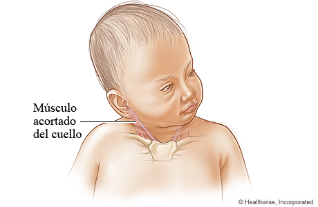 Músculo acortado del cuello (tortícolis)