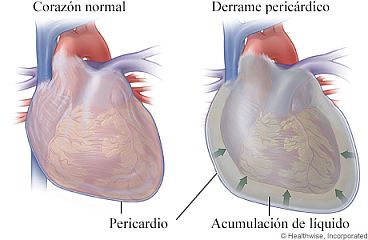 Corazón normal y corazón con derrame pericárdico