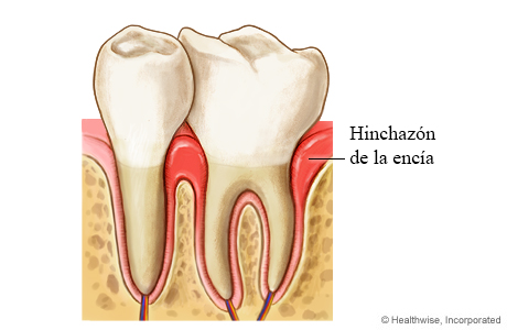 Diente con hinchazón de la encía