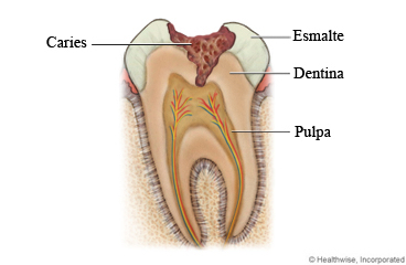 Diente con caries