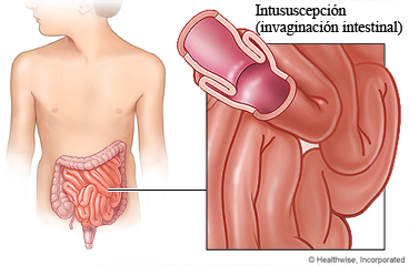 Imagen de la intususcepción