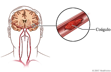 El cerebro con detalle de un coágulo en un vaso sanguíneo.