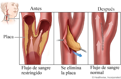 Procedimiento de endoarteriectomía carotídea