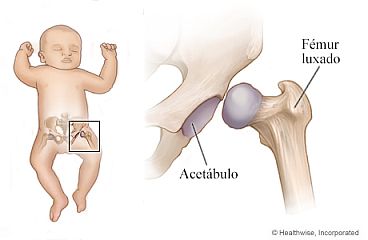 Displasia de cadera en un niño