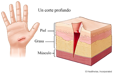 Corte profundo que atraviesa las capas de la mano