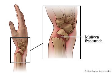 Primer plano de una muñeca fracturada