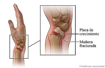 Primer plano de una muñeca fracturada