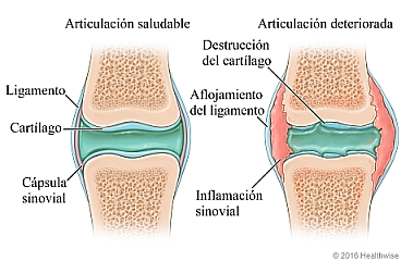 Articulación saludable comparada con una articulación deteriorada