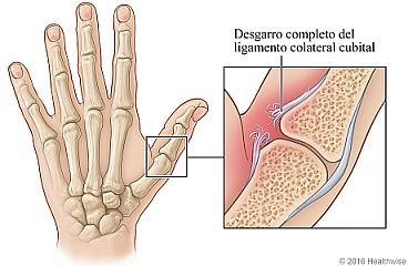 Vista del esqueleto de la mano, con detalle del desgarro completo del ligamento colateral cubital del pulgar