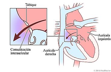 Agujero en el tabique entre la aurícula izquierda y la aurícula derecha del corazón, con detalle de la sangre circulando a través del orificio