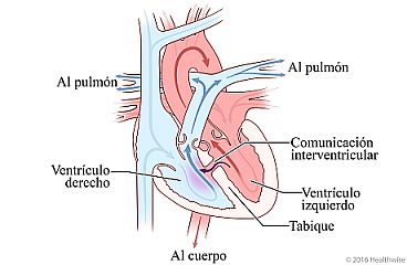 Agujero en el tabique (septo) entre los ventrículos derecho e izquierdo del corazón