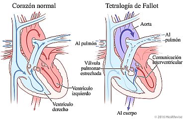 Corazón normal y corazón que muestra los cuatro problemas de la tetralogía de Fallot y el cambio en la circulación de la sangre