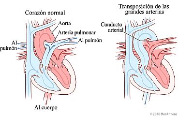 Corazón normal y corazón con transposición de la aorta y las arterias pulmonares y el cambio en la circulación sanguínea