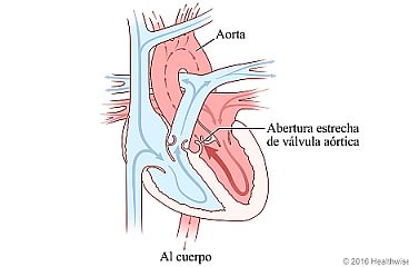 Corazón que muestra la válvula aórtica estrecha y el cambio en la circulación de la sangre