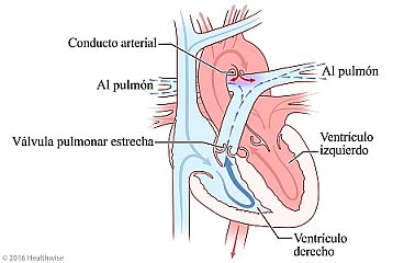 Corazón con válvula pulmonar estrecha y cambio en la circulación de la sangre