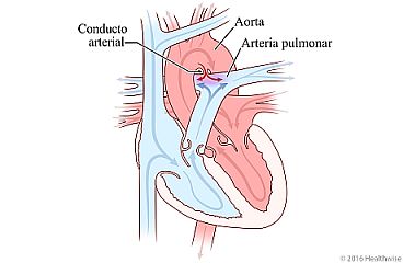 Corazón que muestra el conducto arterial persistente y el cambio en la circulación de la sangre