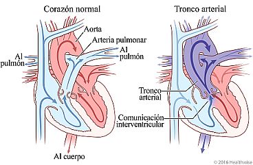 Corazón normal y corazón que muestra el tronco arterial y el cambio en la circulación sanguínea