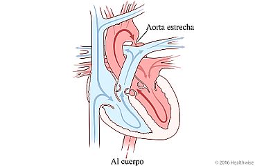 Corazón con aorta estrecha