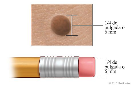 Un lunar, donde se muestra su anchura comparada con la del borrador de un lápiz