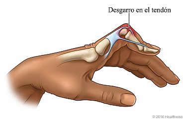 Dedo flexionado debido a un desgarro en el tendón