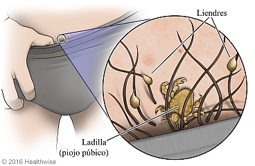 Piojos púbicos cerca de la zona púbica, con primer plano de piojo y liendres