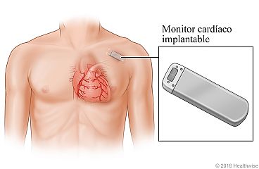 Ubicación del monitor cardíaco debajo de la piel en la parte superior del pecho, con detalle del monitor