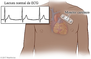 Monitor cardíaco con parche adhesivo y lectura normal de ECG