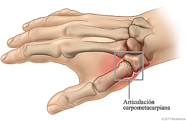 Vista ósea de artritis en la articulación carpometacarpiana