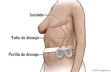 Incisión posterior a la mastectomía con drenajes