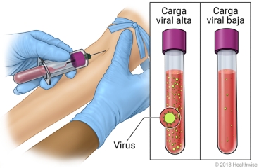 Extracción de una muestra de sangre del brazo, con comparación de muestras con carga viral alta y carga viral baja