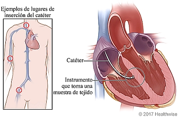 Lugares de inserción del catéter con corte transversal del corazón en el que se ve un instrumento tomando una muestra de tejido