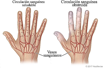 Vasos sanguíneos de la mano, donde se muestra una circulación sanguínea saludable y circulación sanguínea obstruida