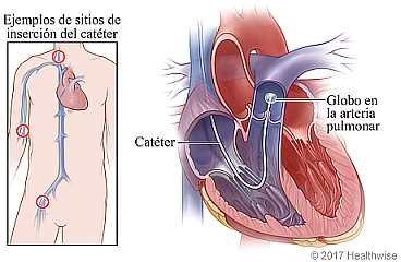 Ejemplos de sitios de inserción del catéter con corte transversal del corazón que muestra el catéter y el globo inflado