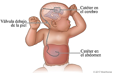 Derivación ventriculoperitoneal, donde se muestra el catéter en el abdomen, el catéter en el cerebro y la válvula debajo de la piel