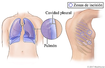 El tórax y el costado, que muestran los pulmones, la cavidad pleural y las zonas de incisión para la toracoscopia