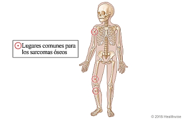 Lugares comunes para los sarcomas óseos, que incluyen encima y debajo de la rodilla y en la parte superior del brazo