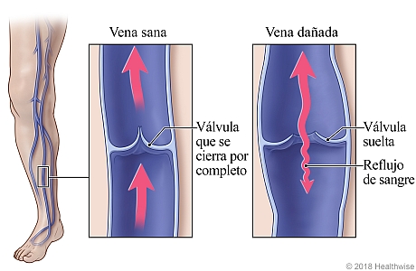 Venas de la pierna, con detalle de una vena y válvula sana y una vena dañada que permite el reflujo de sangre