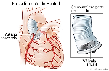 Procedimiento de Bentall, que muestra el corazón, la arteria coronaria y detalle de la sección de la aorta que se ha reemplazado